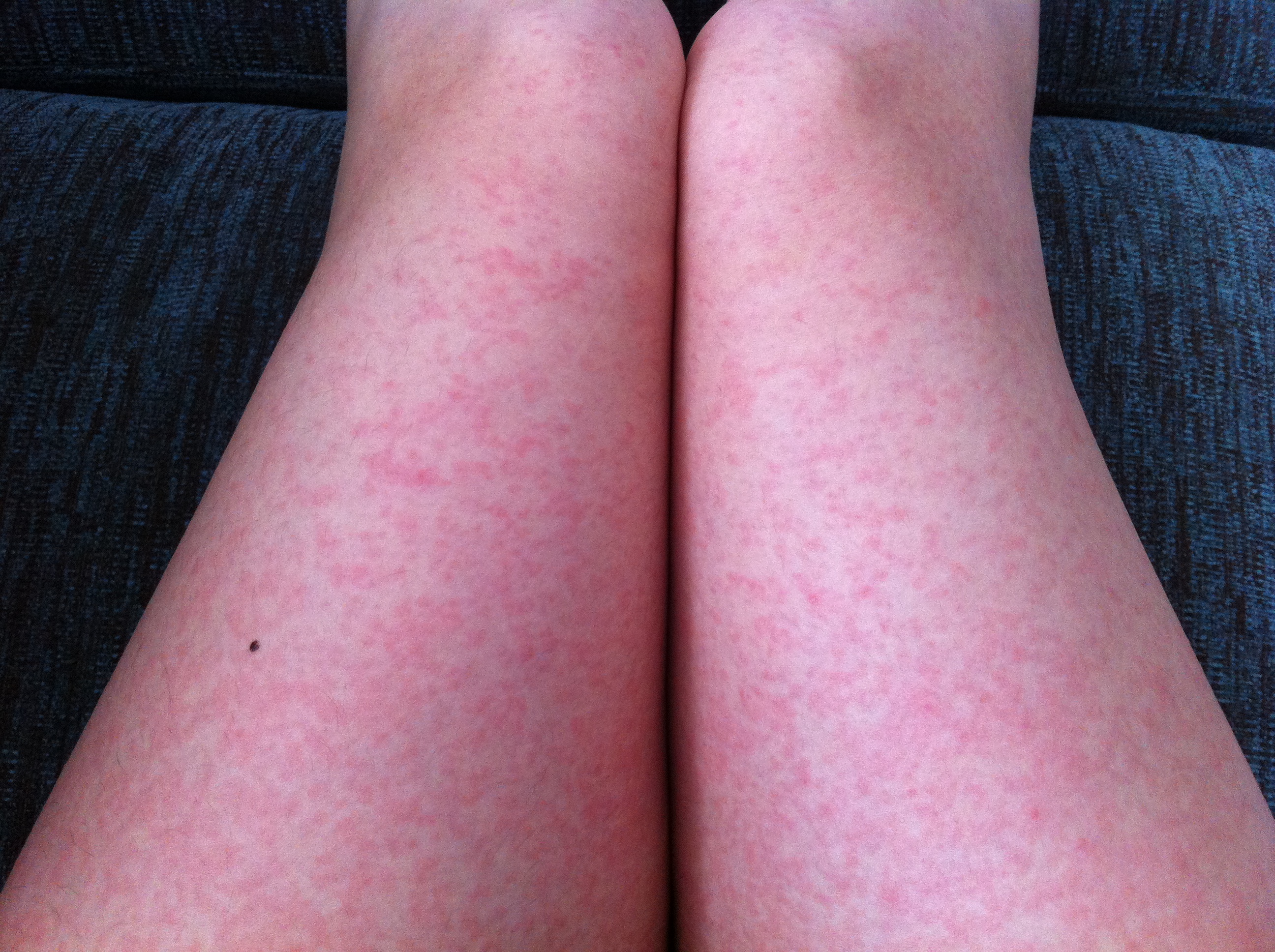筆者が風疹に罹った時の写真