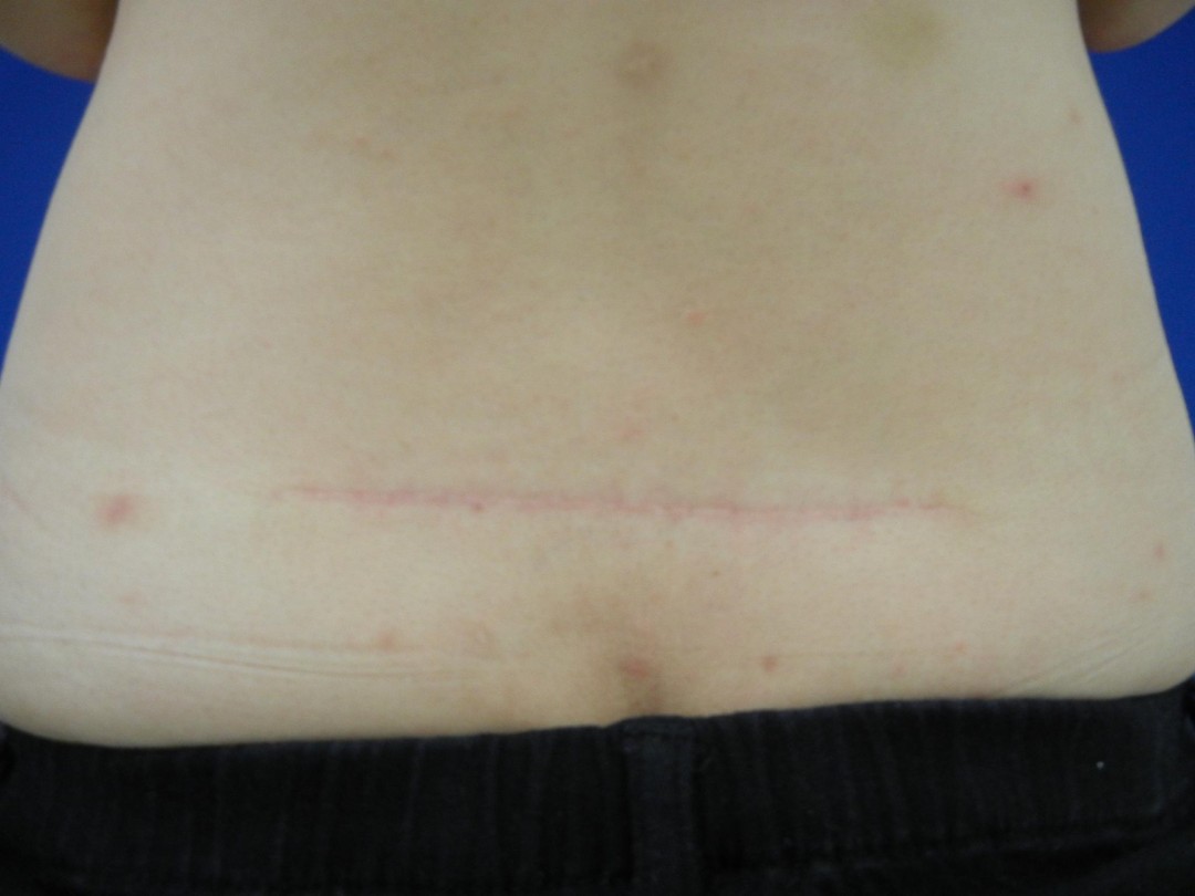切除縫合術（腰）After