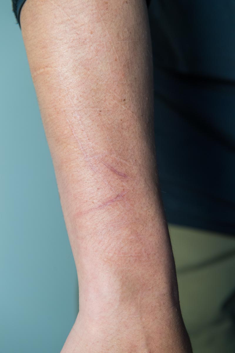 TAK∴さんの腕に刻まれた無数のナイフの跡