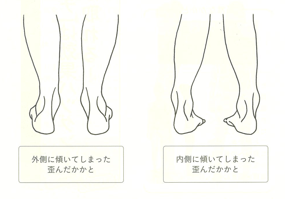 かかとの歪み
