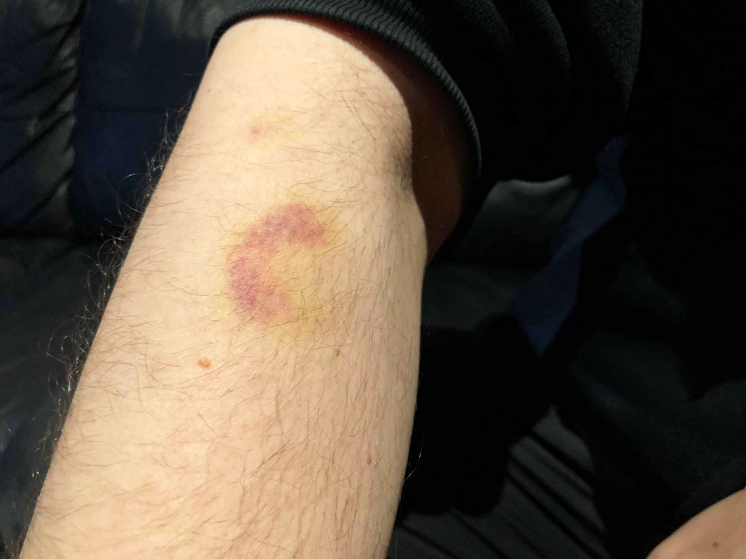 痛々しく残るアザ