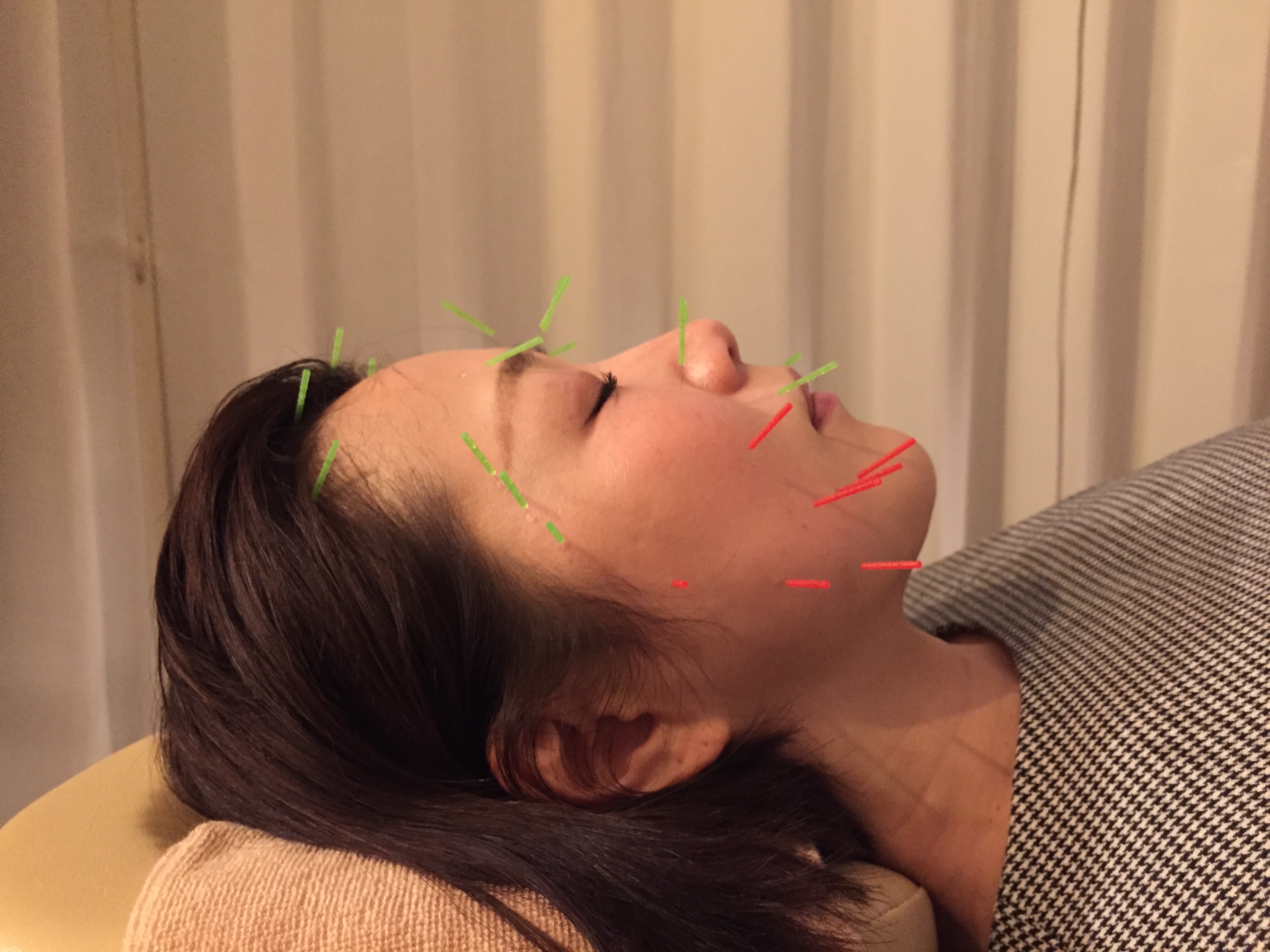 美容鍼（刺し終わり）