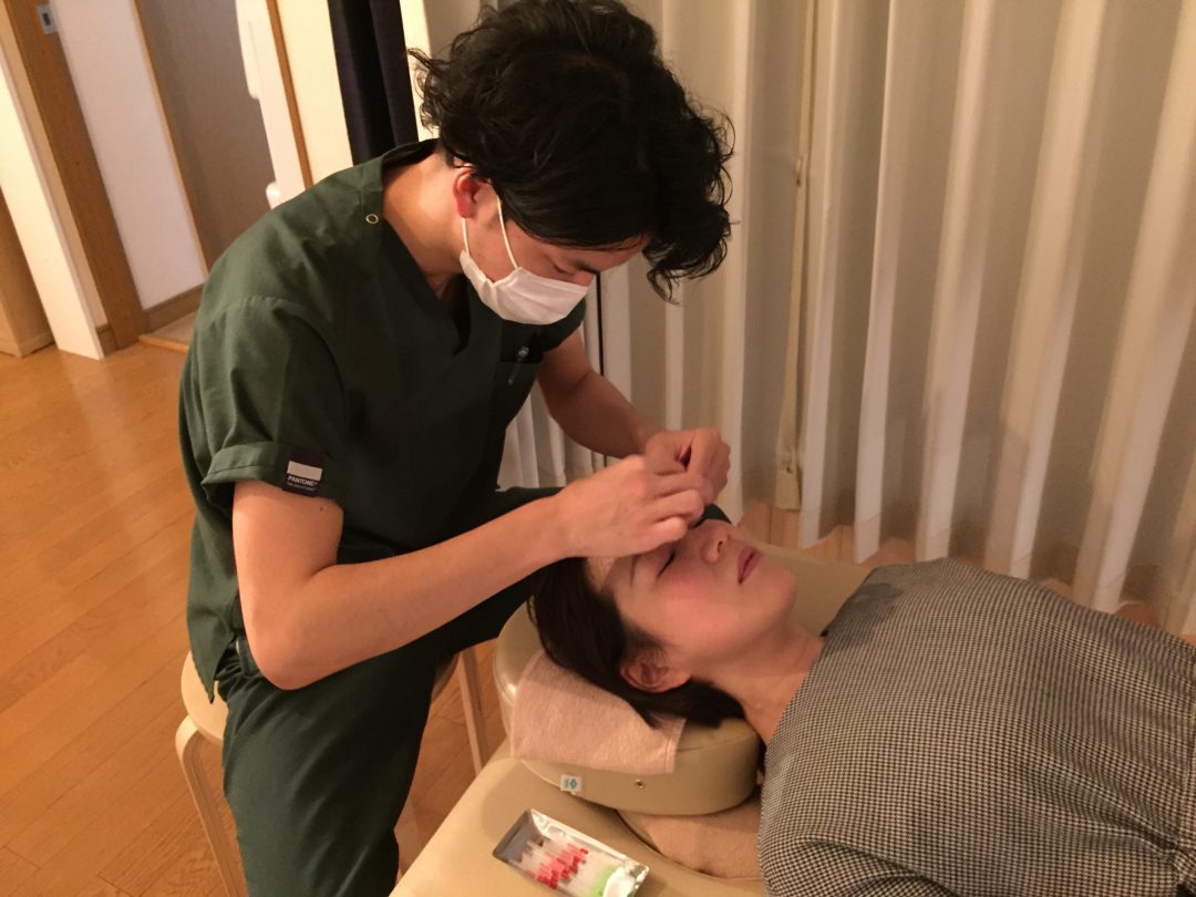 美容鍼（針刺し）