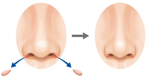 小鼻縮小手術（画像：高須クリニック公式サイトより）