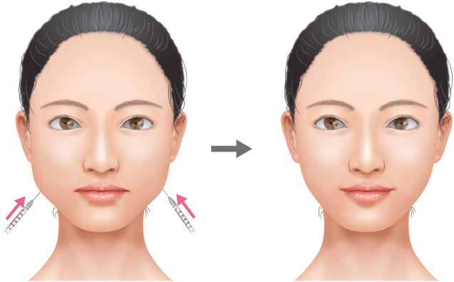 ボトックス注射によるプチ小顔術（画像：高須クリニック公式サイトより）