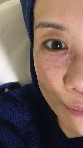 施術後はぽつぽつと顔に点ができました