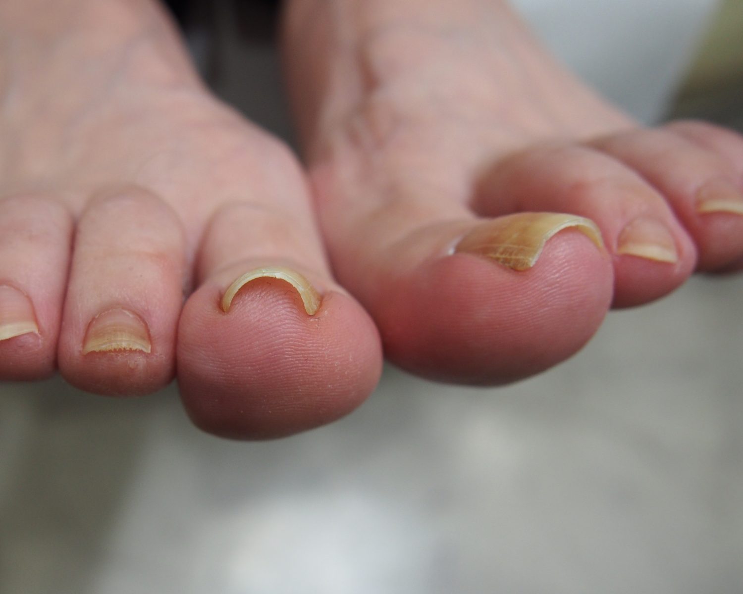 筆者の巻き爪　お見苦しくてすみません……