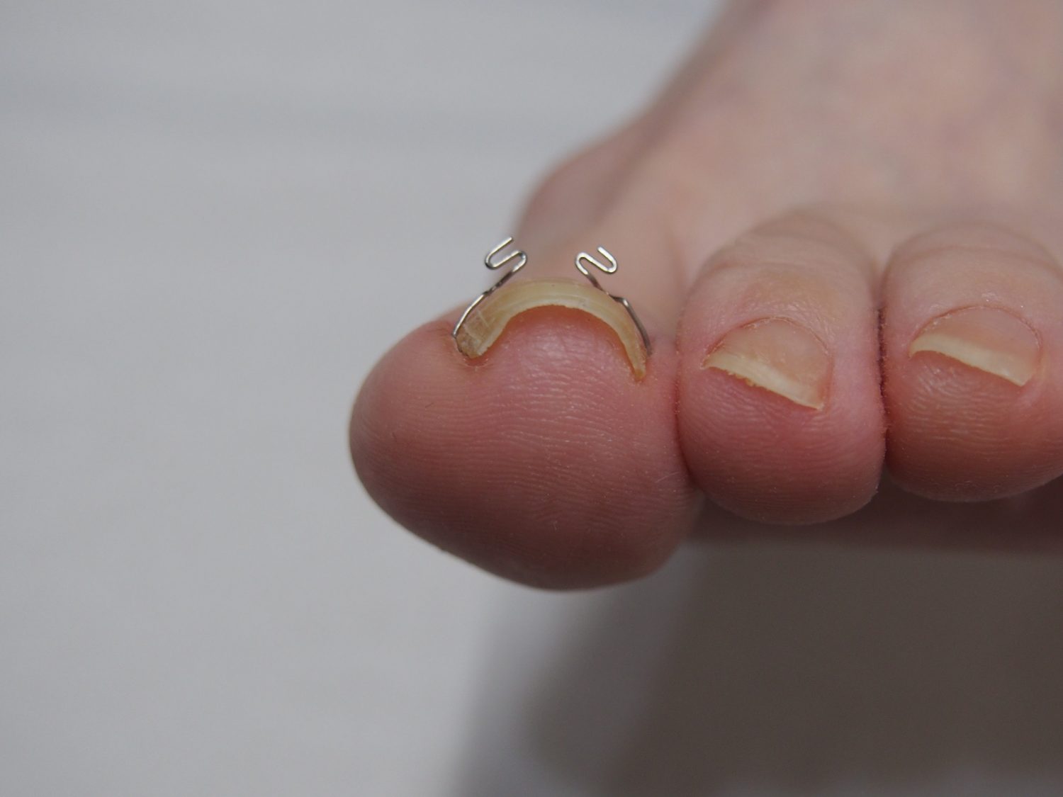 ワイヤーで爪の両端を引き上げて矯正する「VHOワイヤー療法」