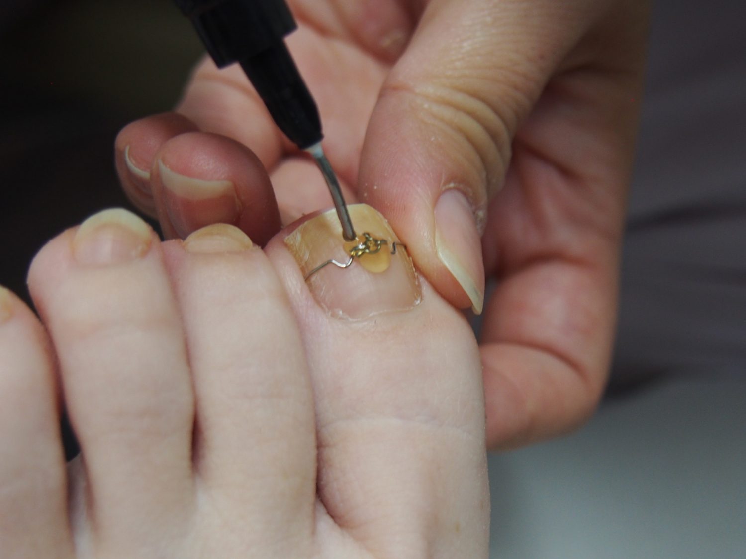 ねじり部分を人工爪でカバーして施術は終了