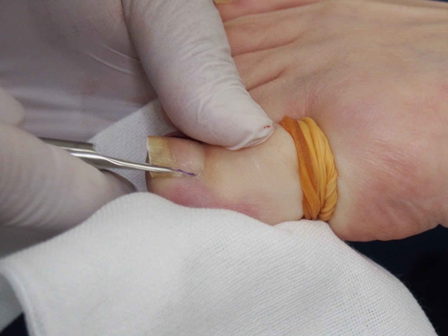 「フェノール法」施術中の様子