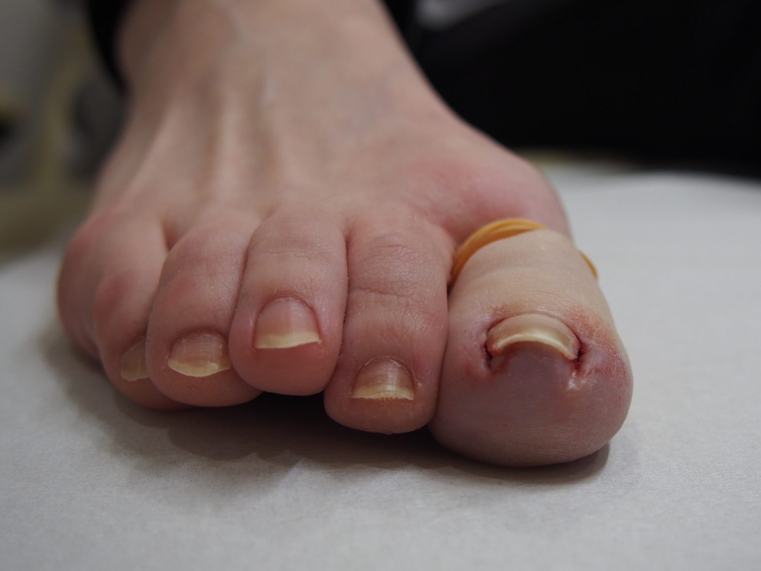 手術直後。食い込んでいた爪の両サイドがなくなりました