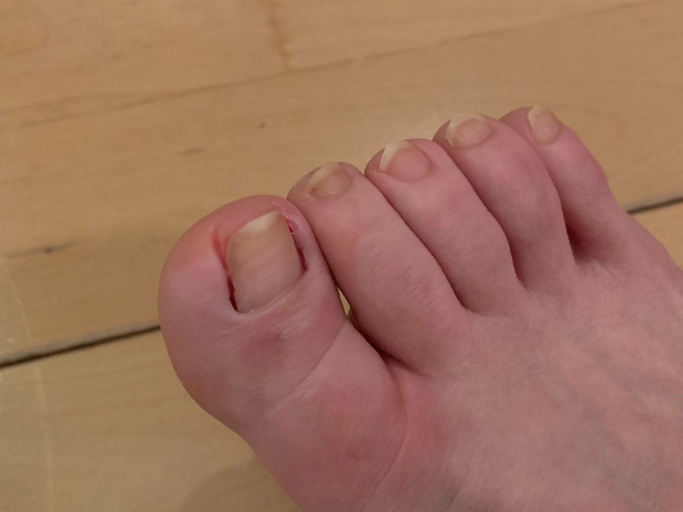 手術当日の夜の様子。これまで食い込んでいた爪の跡がくっきり残っています