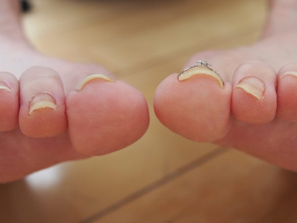 術後2ヵ月　爪の幅は狭くなったけれど、食い込みがなくなり痛みとおさらば！