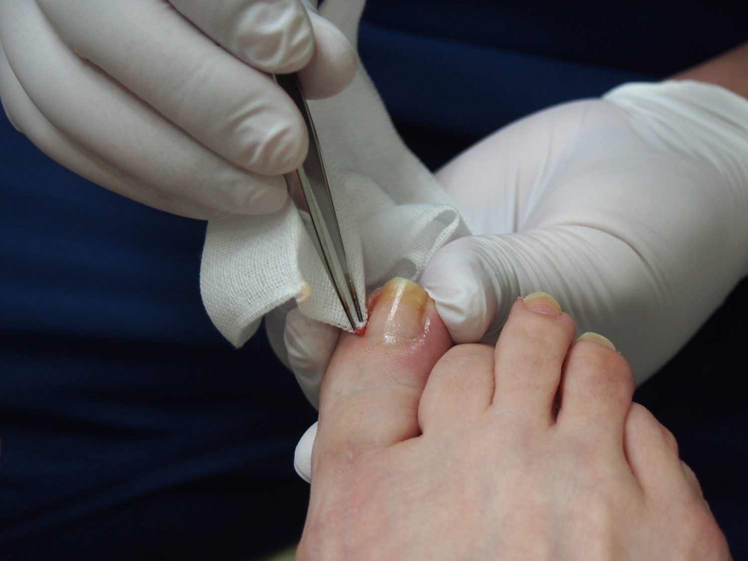 2週間後の診察では先生が患部をきれいにしてくれます