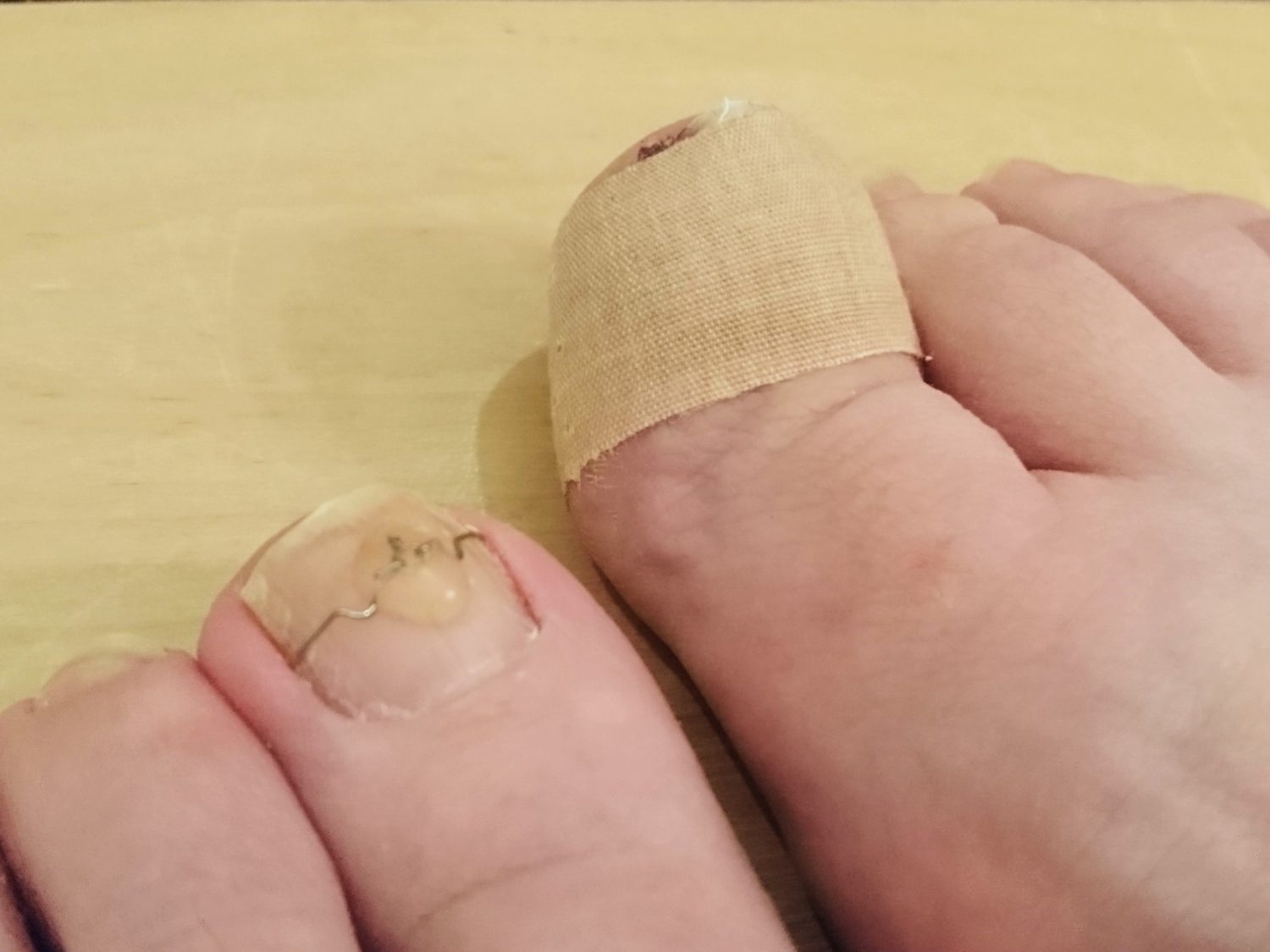 手術当日の帰宅後撮影　左足：VHOワイヤー療法　右足:フェノール法