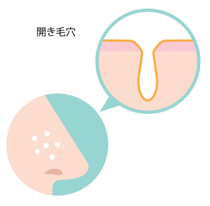 開き毛穴