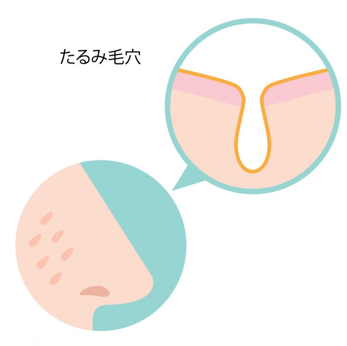 たるみ毛穴