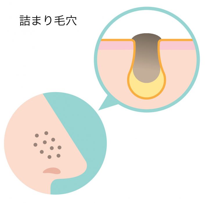 詰まり毛穴