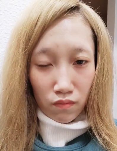 発症から1週間後のようす。この頃が一番つらかった