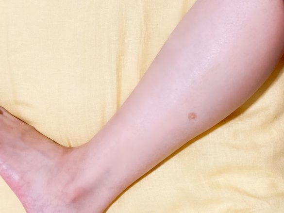 頬の肌荒れが気になるときのツボ