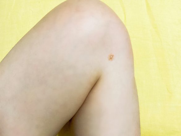 頭頂部の頭痛を感じたときのツボ