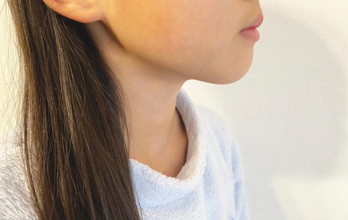 ハイドロコロイド絆創膏