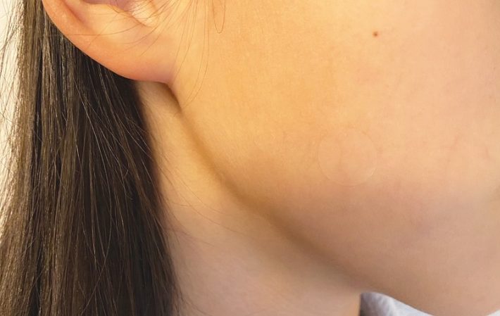 ハイドロコロイド絆創膏