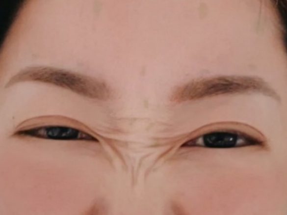 ボトックスを打つ前の筆者