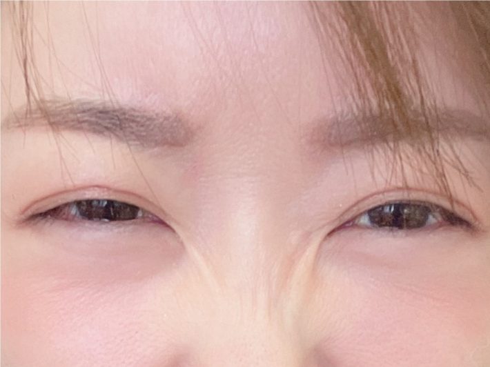 ボトックスを打った後の筆者