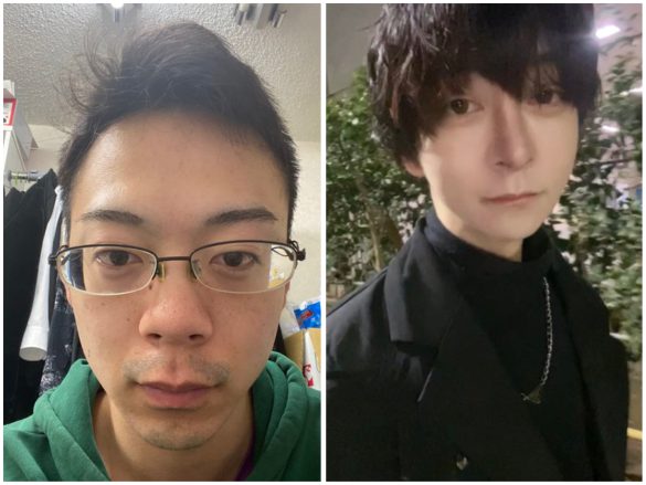 ゆうり　骨延長