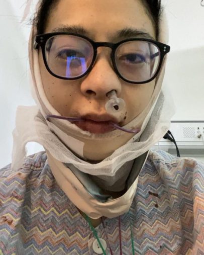 ゆうり　骨延長