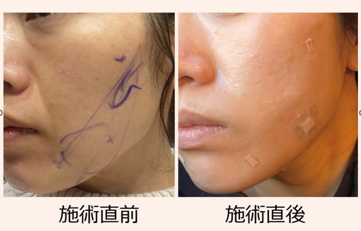 「糸リフト」施術の直前直後