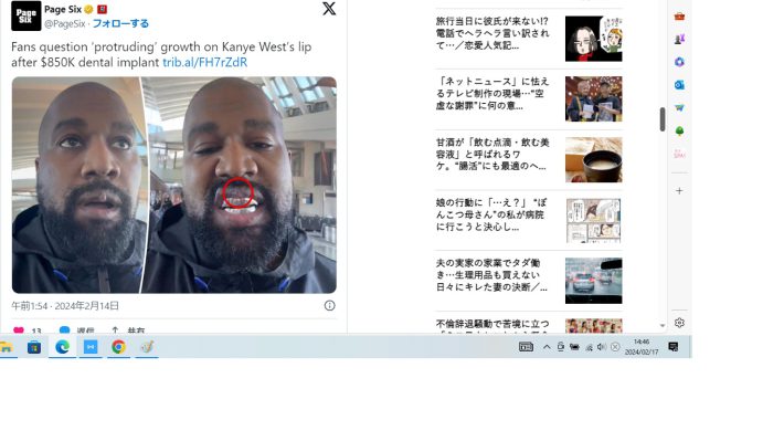 1億2千万円超のチタン製の入れ歯