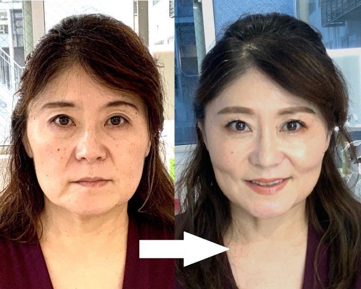 Nさんビフォーアフター