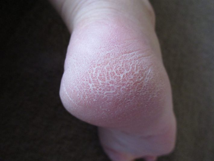 かかと　ひび割れ