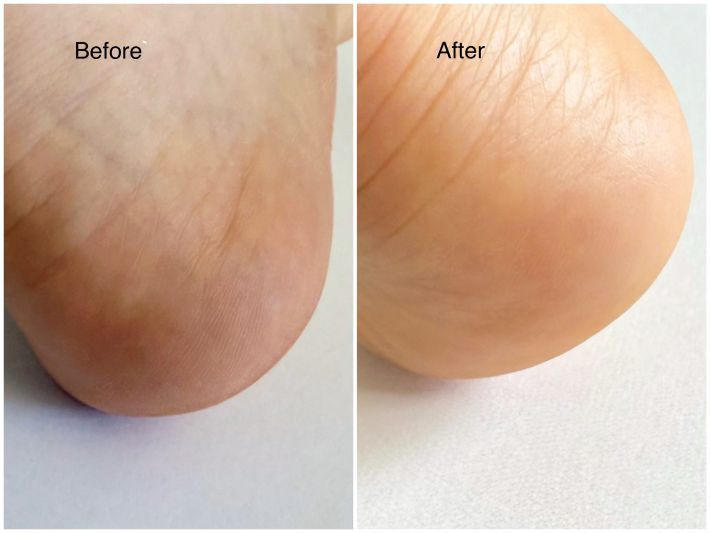 キュレル かかとケアマスク