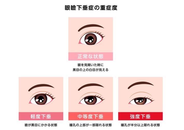眼瞼下垂