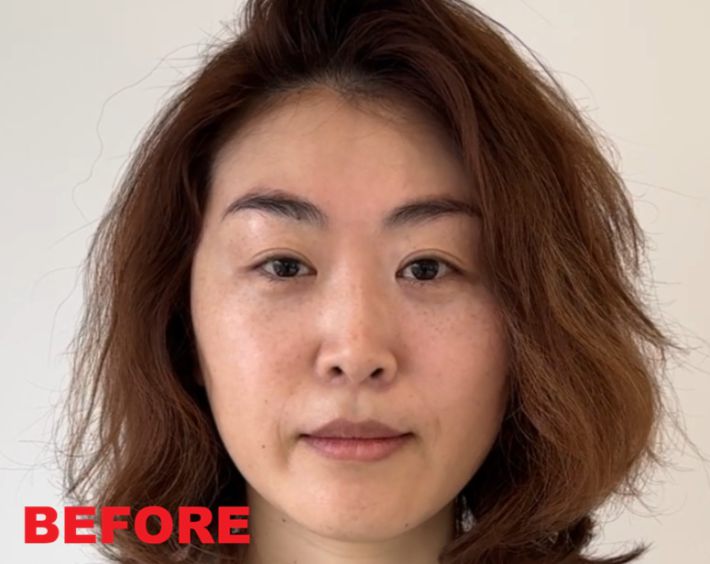 まぶたのたるみ