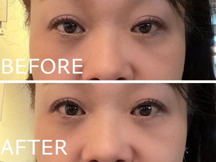 左：眠そうな目がお悩み、右：セルフケア後。黒目の露出範囲が広がり目がぱっちり